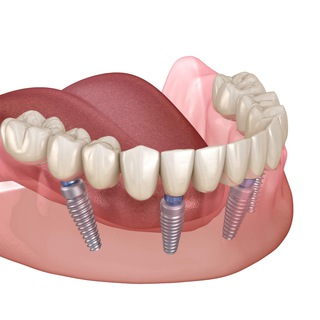 Аватар TopDent — имплантация зубов